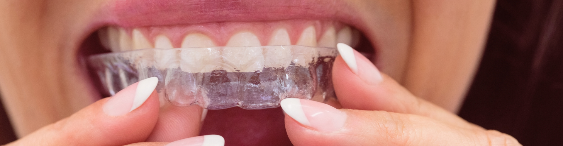 Woman placing clear aligner in mouth.